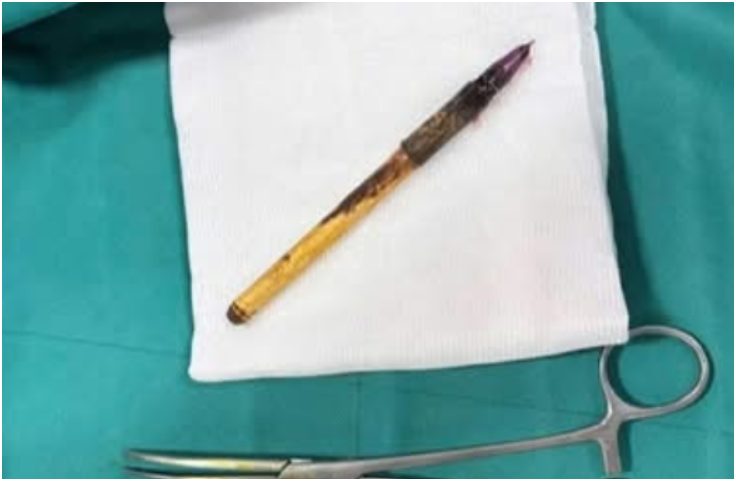 CA vào cuộc vụ bé trai lớp 6 ở Hà Nội nghi bị nhét bút vào hậu môn: Thôi xong thật rồi