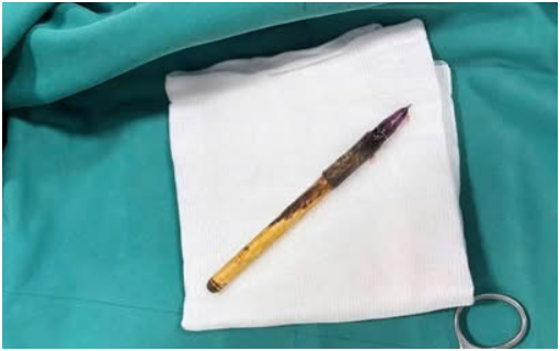 Vụ bé trai lớp 6 bị nhét bút vào hậu môn: Vì sợ bị đ:á::nh nên không dám kể với gia đình