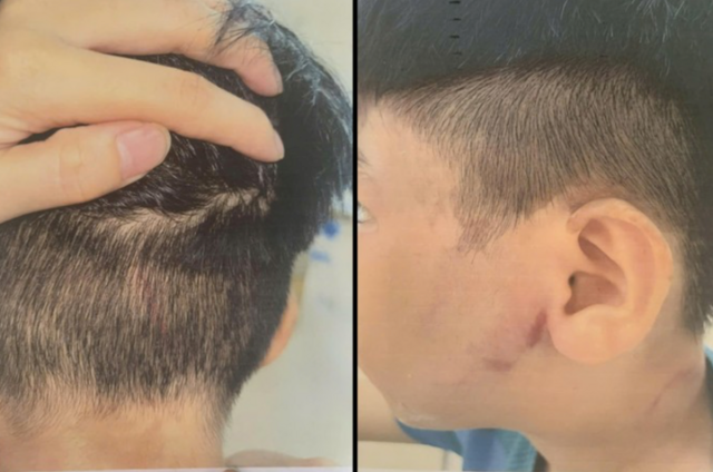 Bé trai 8 tuổi hoảng loạn cầu cứu bà ngoại sau khi bị cha đánh: Cơ thể đầy vết bầm, xây xát khiến ai cũng xót xa